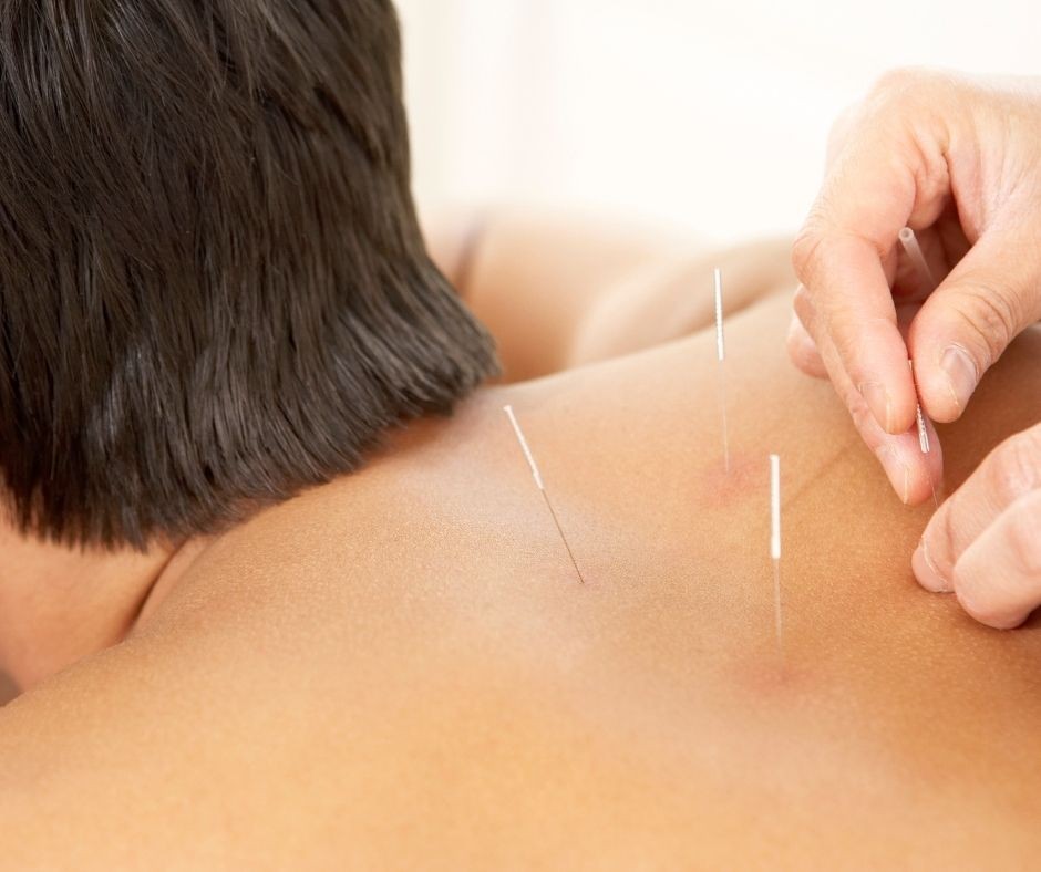 Acupuncture and Cupping: Boost Your Sports Recovery